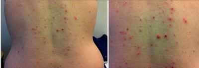 Abbildung 1 und 2: Stark juckender Hautausschlag am Rücken bei einer 53-jährigen Patientin unter Telaprvirbasierter Triple-Therapie nach 3 Wochen Therapiedauer.