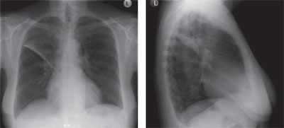 Abbildung 3a und 3b: Röntgenthorax der Patientin.