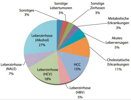 Abbildung 2: Häufigste Indikationen für eine Lebertransplantation in den letzten  10 Jahren (Universität Heidelberg). Die häufigste Indikation war die ALE, gefolgt  von der HCV-Infektion.