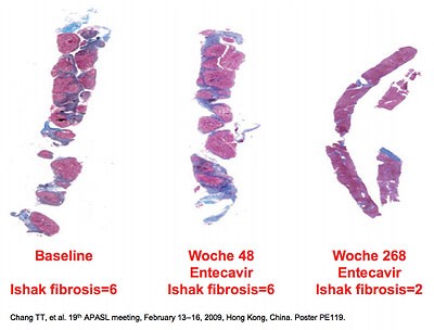 Abbildung 2: Regression einer Leberzirrhose unter Entecavir