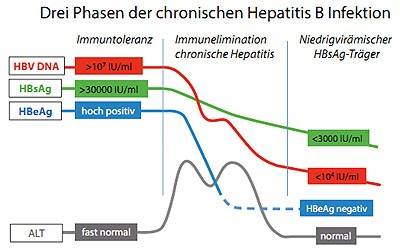 Abbildung 1: Schematischer Verlauf einer chronischen Hepatitis B ohne Therapie.  Die chronische Hepatitis B verläuft typischerweise über Jahre oder Jahrzehnte, wobei die einzelnen Phasen  unterschiedlich lange dauern können. Viele chronisch Infizierte erreichen die niedrigvirämische Phase nie oder  erst nach Ausbildung einer Leber-Zirrhose. Die im Text vorwiegend verwendete Mengenangabe für HBV DNA  in Molekülen/ml ist ungefähr um den Faktor 5 höher als die international empfohlene International Units (IU), die  willkürlich festgelegt sind.