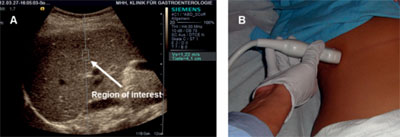 Abbildung 2: Acoustic Radiation Force Impulse imaging (ARFI)