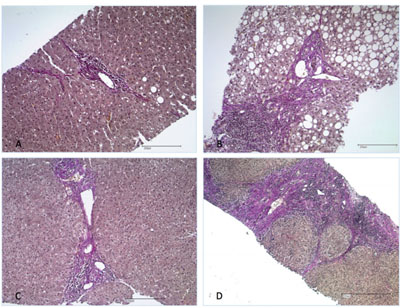 Abbildung 1: Histologische Bilder mit unter-  schiedlichen Fibrosegraden (F1 - F4)   (Elastica-van-Gieson [EvG]).