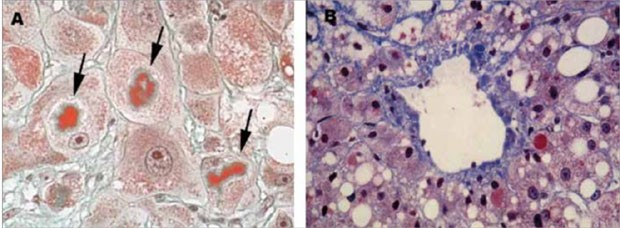 Abbildung 4: Typische histologische Zeichen einer alkoholischen Lebererkrankung mit A: Mallory-Denk-Bodies (siehe Pfeile) und B: einer typischen perivenulären Fibrose  als prognostisch ungünstige Zeichen einer alkoholischen Lebererkrankung