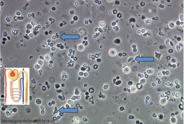 Abb. 1 Darstellung des Phasenkontrasturins eines aktiven nephritischen  Sedimentes mit Akanthocyten, die typisch glomerulär deformiert sind